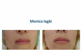 ”Interventiile estetice cu acidul hialuronic Restylane mi-au imbunatatit si viata de cuplu”