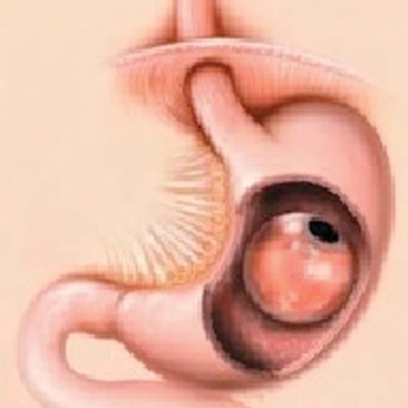 Tehnici endoscopice de slabire – balonul intragastric