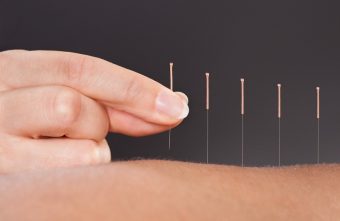 Acupunctura te scapa de obezitate