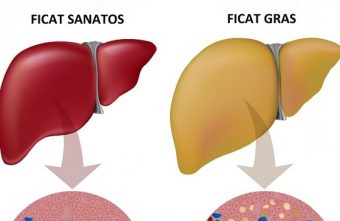 Dieta pentru ficat gras, esentiala pentru evitarea complicatiilor