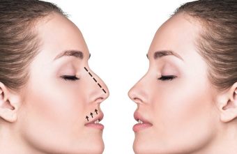 5 beneficii ale rinoplastiei