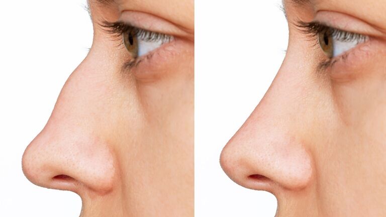 Rinoplastie: 7 beneficii importante