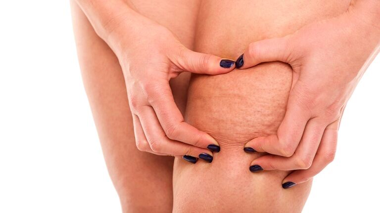 Celulita: ce este, tipuri de celulită, alimente care o combat, trucuri eficiente