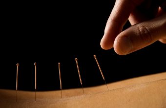 Acupunctura: ac de cojocul obezitatii
