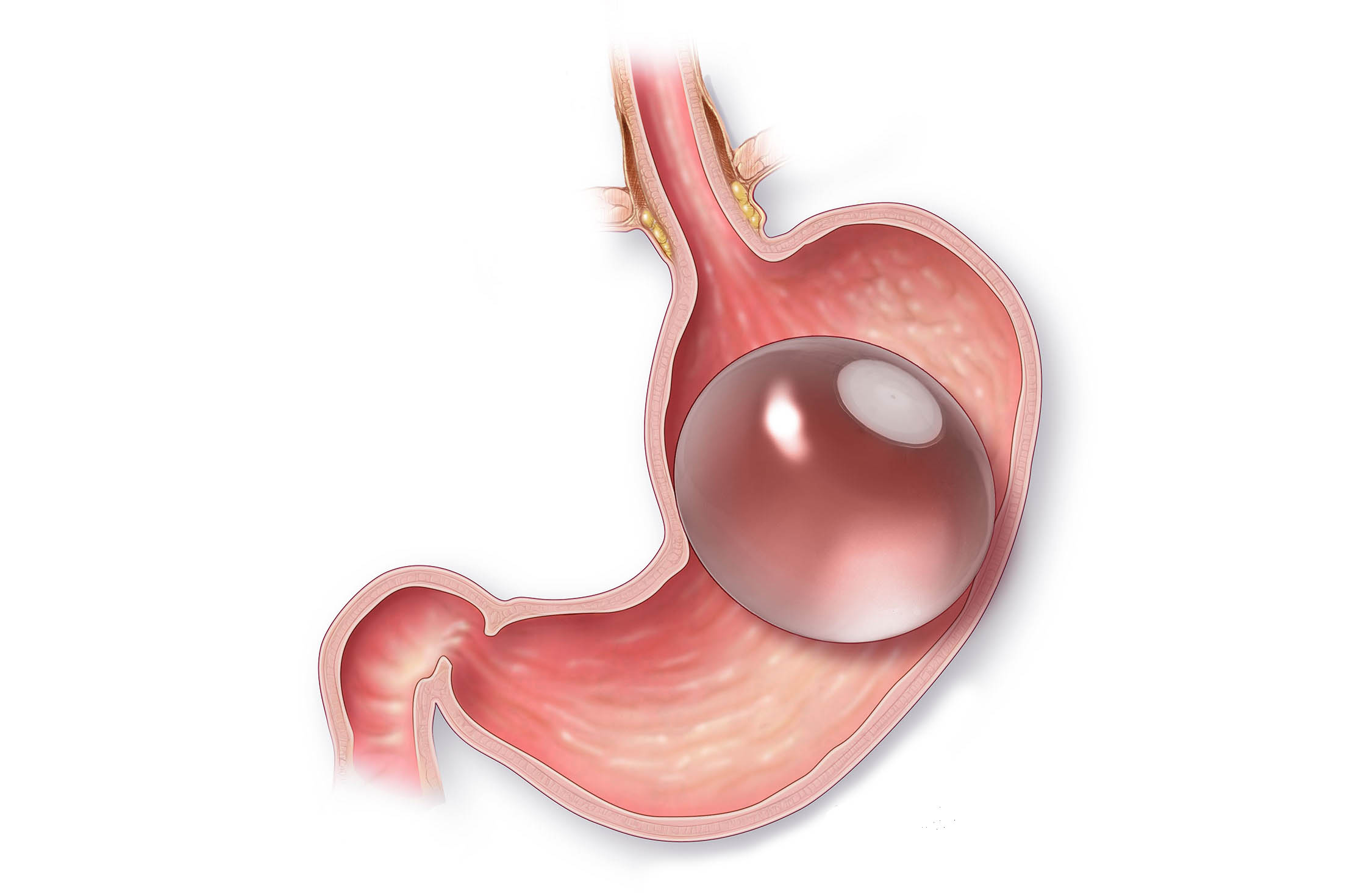 Chirurg bariatric: „Cu balonul gastric se pot da jos zeci de kilograme”