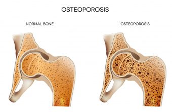 Medic endocrinolog: „Excesul ponderal protejeaza de aparitia osteoporozei”