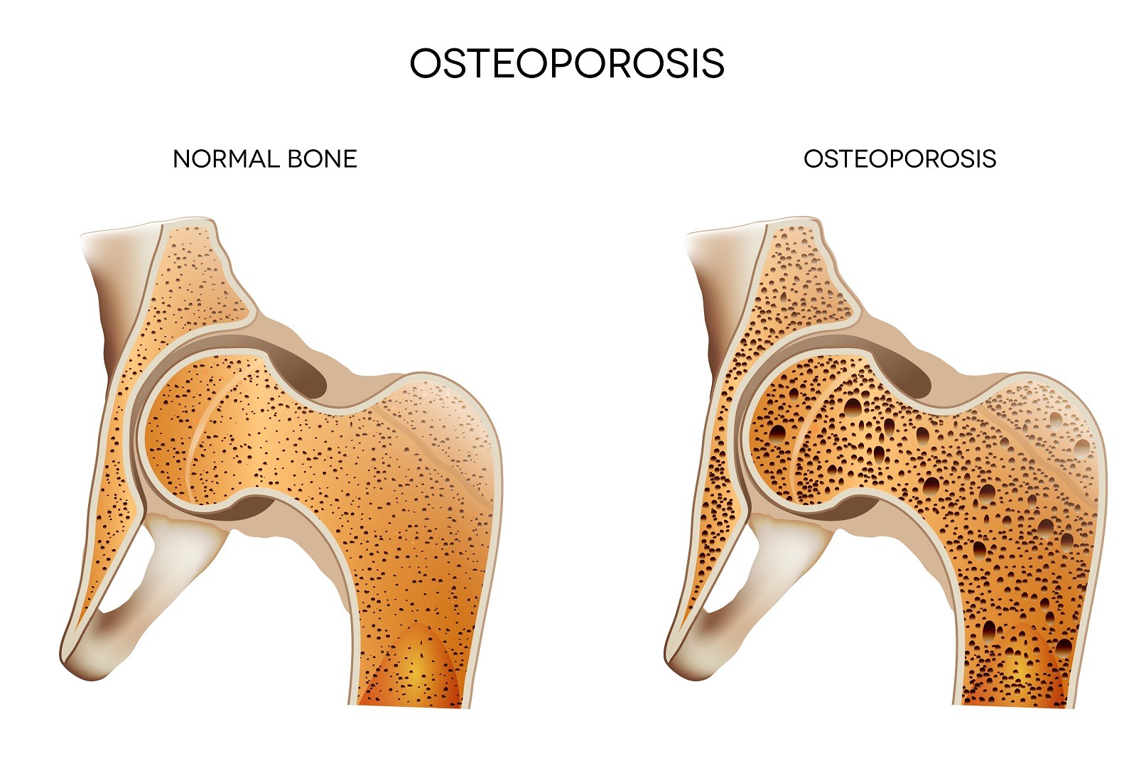Medic endocrinolog: „Excesul ponderal protejeaza de aparitia osteoporozei”