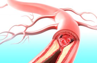 Legatura dintre colesterol si boala arteriala periferica