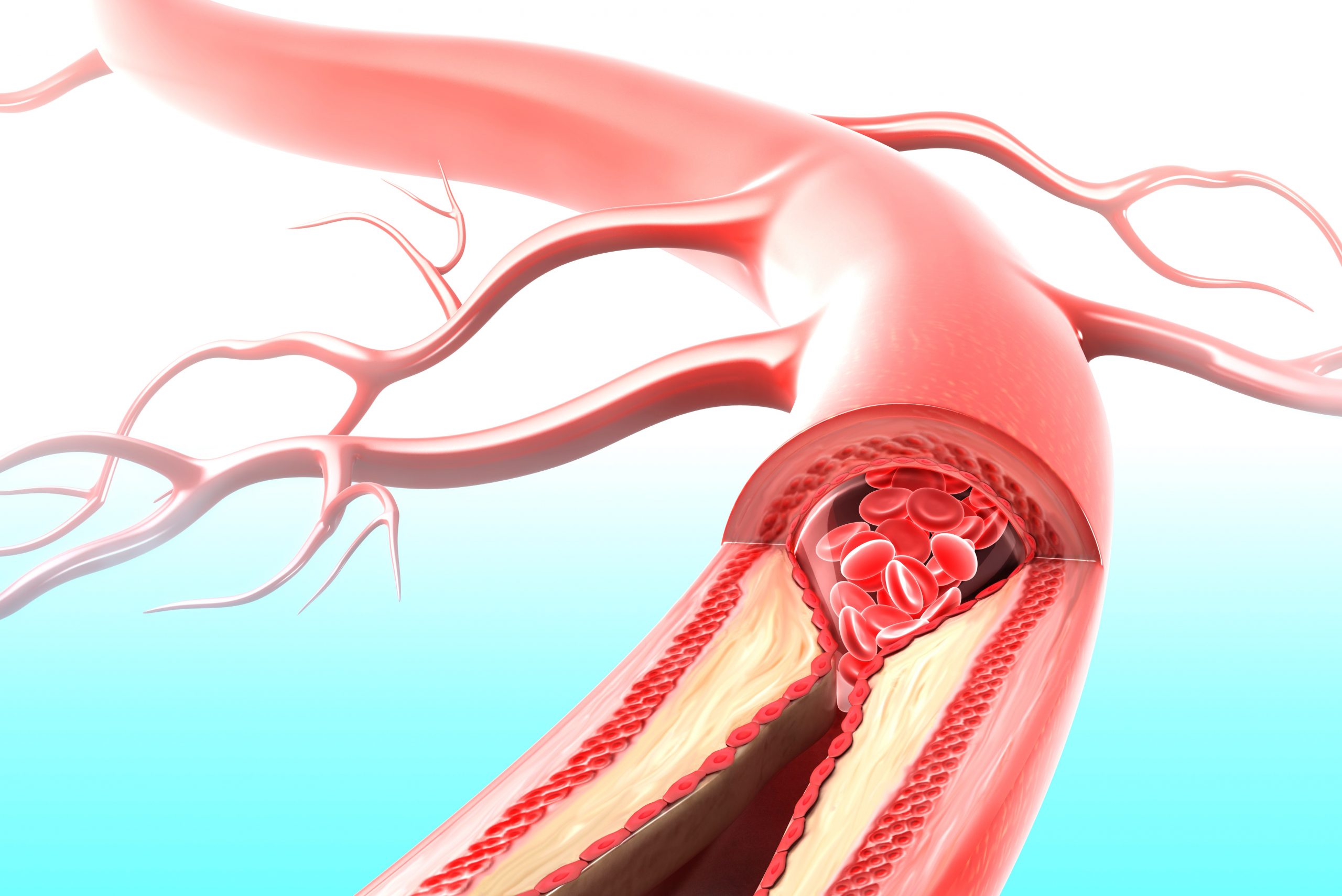 Legatura dintre colesterol si boala arteriala periferica