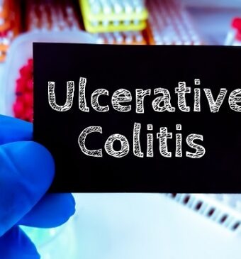 Colita ulcerativă – semne, simptome și tratament