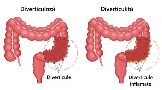 Lista de alimente interzise în diverticulită