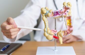 Cancerul colorectal în rândul tinerilor și factorii de risc asociați