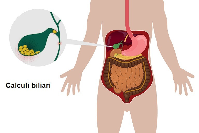 Calculi biliari (pietre la fiere) – cauze, simptome și tratament