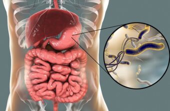 Helicobacter pylori, de la simptome la diagnostic și tratament