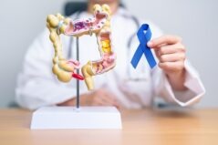 cancerul colorectal este o problemă de sănătate publică
