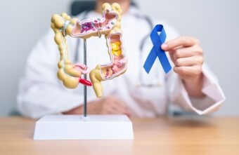 cancerul colorectal este o problemă de sănătate publică