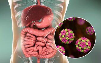 Astrovirus copii și adulți: simptome, complicații, prevenție