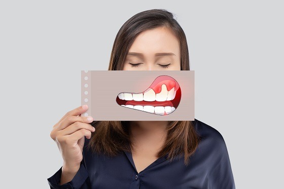 inflamație gingivală