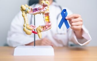 România și cancerul colorectal – codașă la screening, fruntașă la incidență