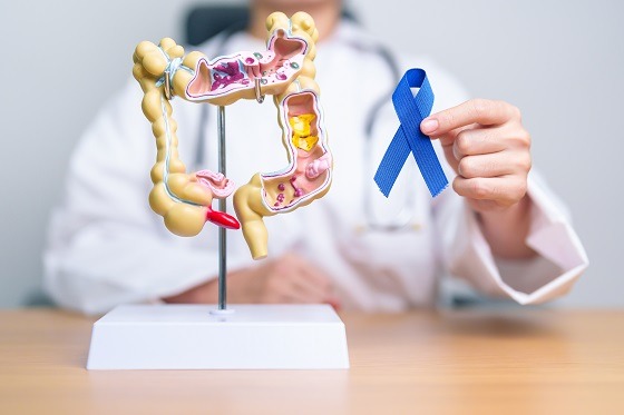 România și cancerul colorectal – codașă la screening, fruntașă la incidență