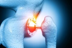 Exerciții de recuperare pentru acasă după operația de proteză de șold