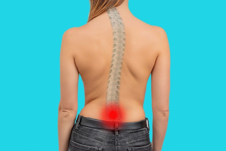 Cele mai bune exerciții recomandate în scolioză