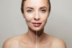 Nutritia si acneea – care sunt legaturile?