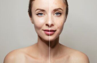 Nutritia si acneea – care sunt legaturile?