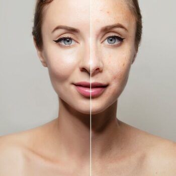 Nutritia si acneea – care sunt legaturile?