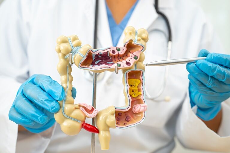 Colita pseudomembranoasă: cauze, simptome, tratament si recuperare