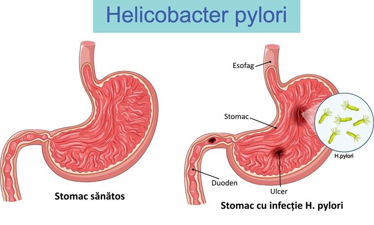 Ulcer duodenal: ce este, simptome, cauze, tratament și regim alimentar